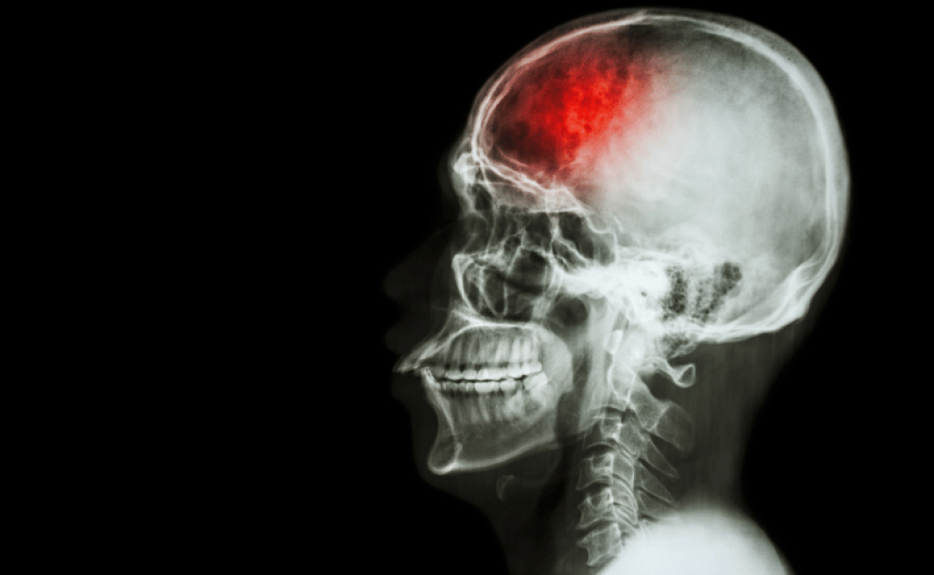 brain attack Panchkula
