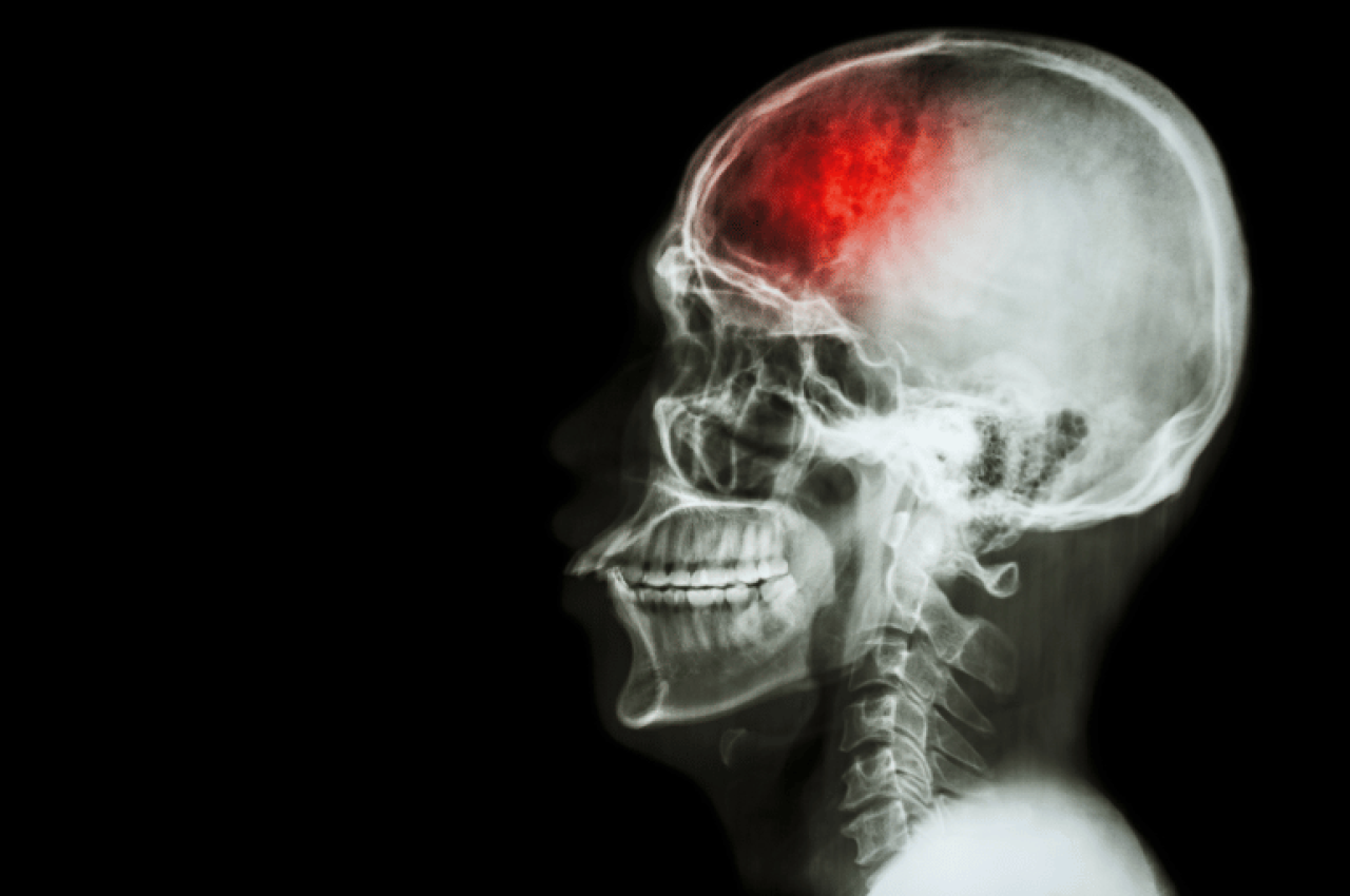 Brain attack panchkula